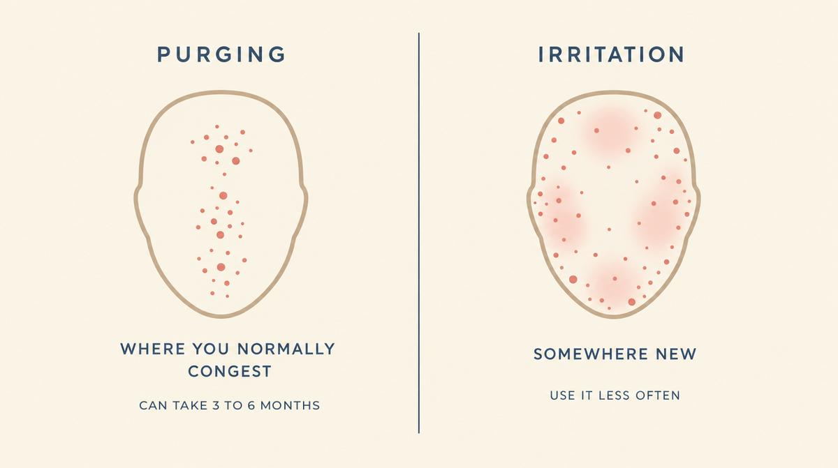 Diagram distinguishing purging, which appears where you normally congest and can take three to six months to settle, from irritation, which appears in new areas.