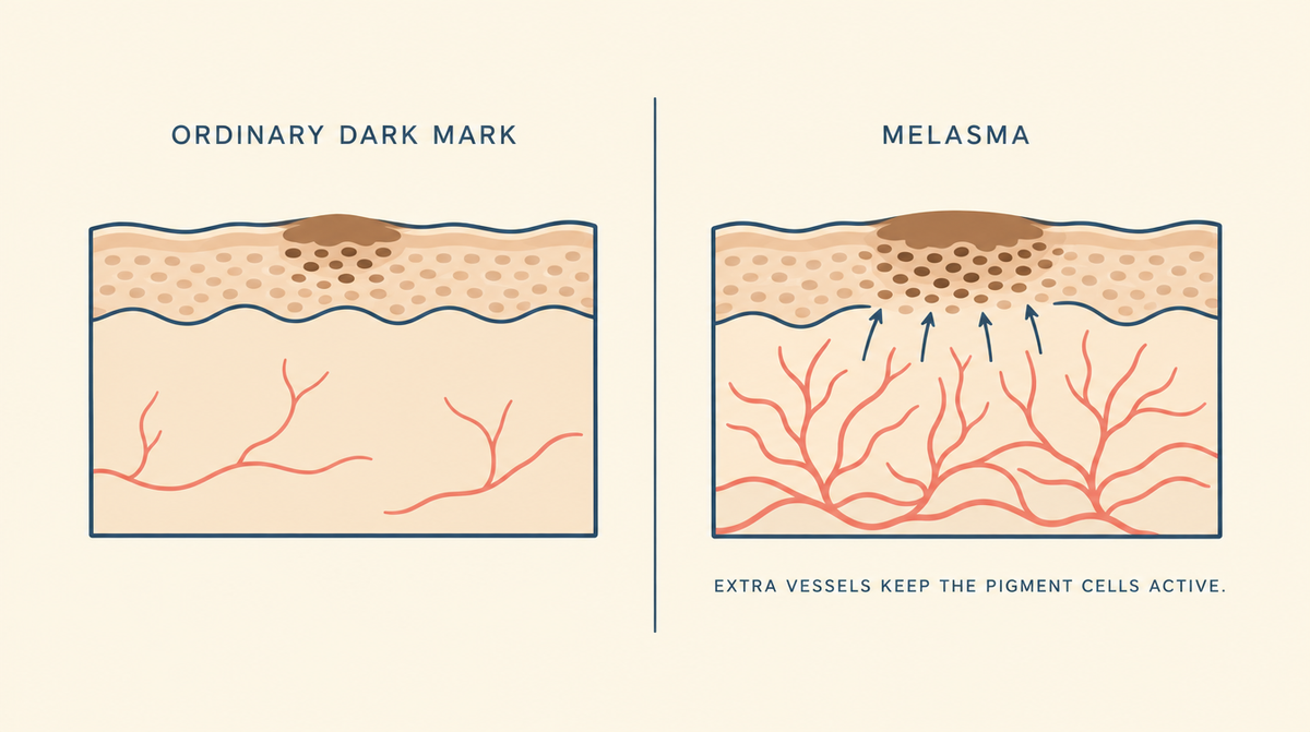 Diagram comparing an ordinary dark mark with melasma, which has noticeably more blood vessels beneath it keeping the pigment cells active.